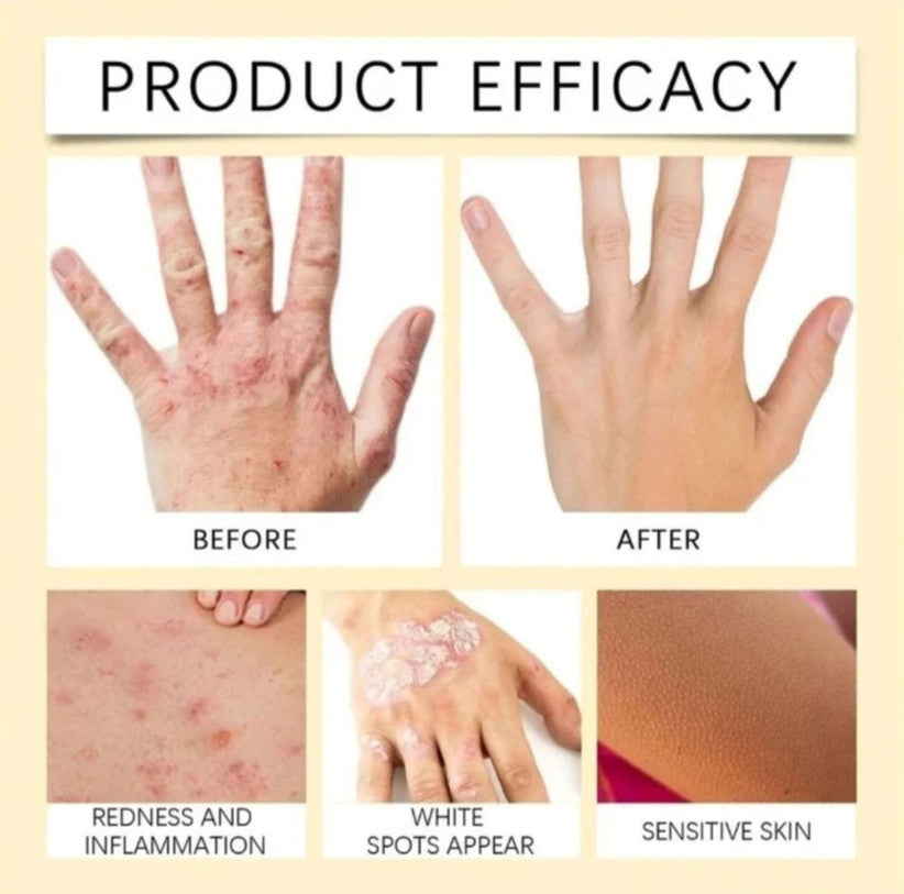 VitiGO™ Revitalizing Bee Venom Cream | Effective Solution for Vitiligo, White Spots & Skin Revitalization  - Pack of 3
